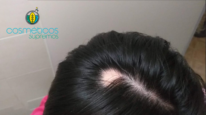 Elimina la Alopecia