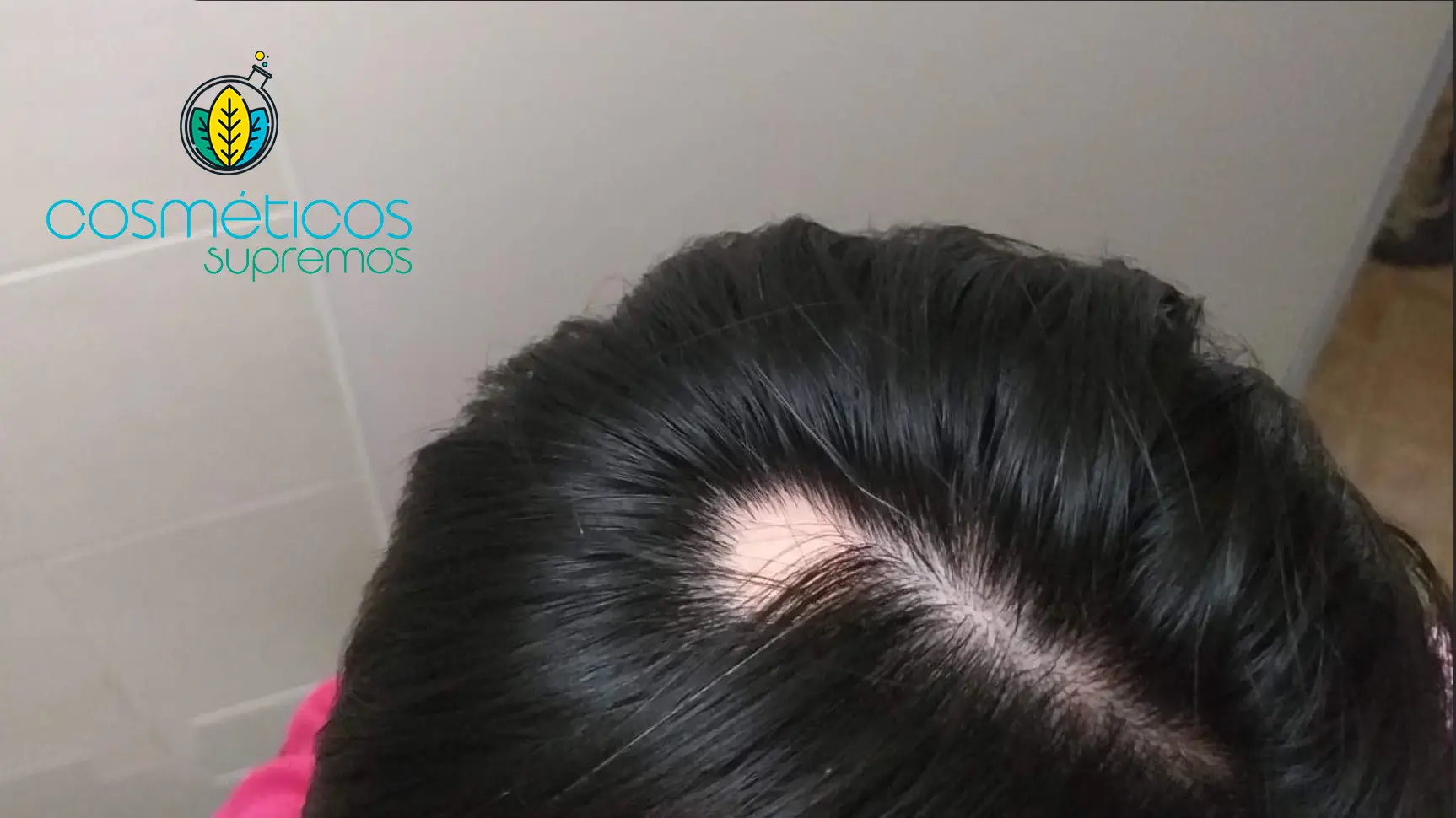 Elimina-la-Alopecia
